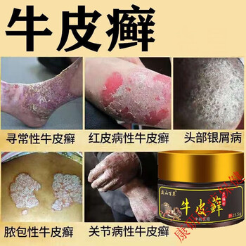 银屑痒外用草本顽固皮肤瘙痒手足痒股癣体癣大腿内侧阴囊潮湿狼毒清 1