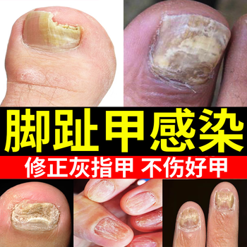 韩丽熙修正灰指甲护理灰指甲脱甲膏液专用治1疗脚趾甲 1盒