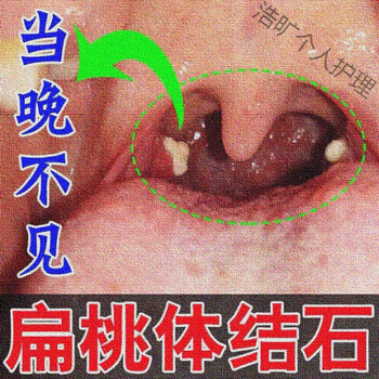 扁桃体结石漱i口水去除工具去口i臭结石吸取器去除工具消毒口腔