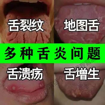 口腔扁平苔藓舌炎烂舌头舌头发白舌头起泡口干舌乳头炎灼烧感疼痛