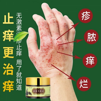 顽达康苗家清肤霜皮肤瘙痒汗i疱ii疹湿ii疹成人手脚水泡刺痒止痒王