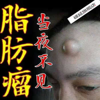 祛脂肪瘤訷器专攻36种全身皮下多发性脂肪瘤消瘤膏祛粉瘤囊肿一盒装