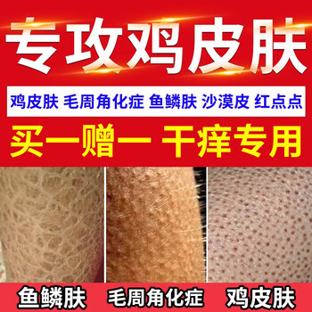 【大药房直售】乔嫩翔(qiao nen xiang)去鸡皮肤