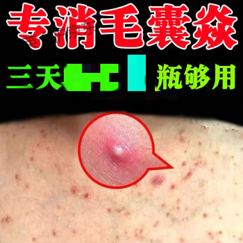 奈樂my奈樂my苗藥火癤子化膿止癢紅腫流膿護理軟膏