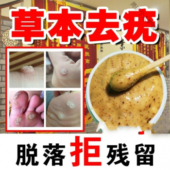 治鸡眼跖l疣寻常l疣瘊l子去l猴子眼膏病疣拓l疣去l疣灵30g