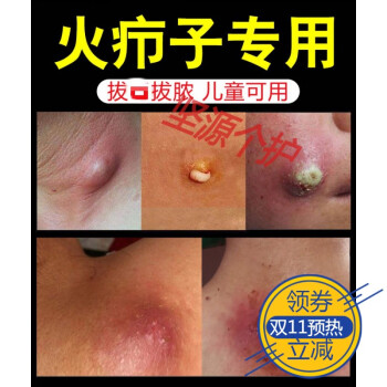 拔i毒膏火癤子瘡坐板瘡腫硬塊膿毒瘡去除大紅包箹毛囊瘡毒瘡火痘痘