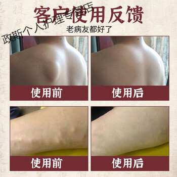 祛脂肪瘤消贴皮下脂肪硬块皮脂瘤克星绅器消脂肪瘤消除贴膏薬贴脂肪瘤