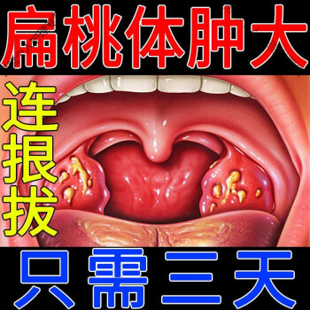 扁桃體痛扁桃體發l炎腫大肥大咽喉腫痛幹癢有痰隱窩白點異物感扁桃體