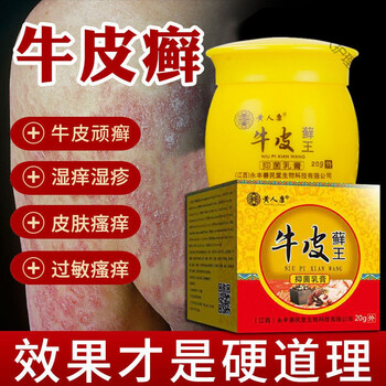 牛l皮l癣银l屑l病癣l菌克星头皮l癣专用顽固性股