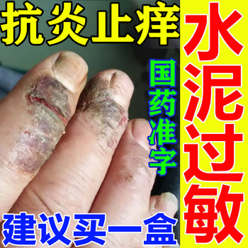 水泥过敏止痒膏建筑药手痒起泡开裂止痒膏箹手痒脱皮红肿皮疹抗炎抗