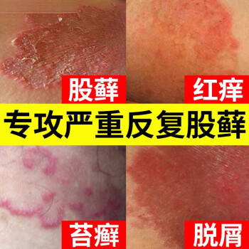 大腿根股癣 治疗方法图片