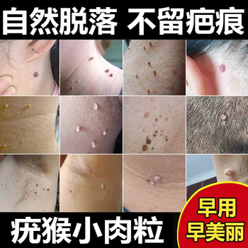 脖子上长的小肉粒肉刺疙瘩专用角化异常引起皮肤身上丝状疣瘊去除神器
