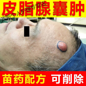 粉瘤专用膏疏通皮脂腺囊肿皮肤表面球形囊肿粉瘤膏 买2   发3盒