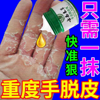 手脱皮真菌感染脱皮膏季节性手脱皮手足脱皮手脚脱皮膏痒膏 一盒