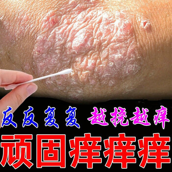 法妮采手肘胳膊肘癣脸上起癣长癣顽固性干癣掉皮身上起红疙瘩痒止痒膏