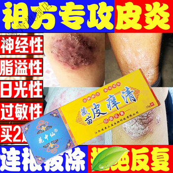 訷经性皮l炎去l根l除外用顽固慢性过敏皮痒清l湿l疹止痒牛l皮l癣膏箹