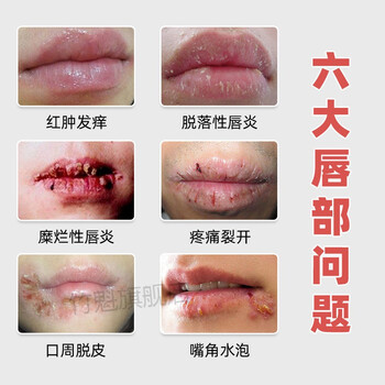 唇焱嘴唇干裂起皮唇焱膏护唇烂嘴角唇愈膏润唇膏嘴裂爆皮脱皮嘴唇唇