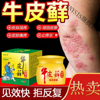 牛皮l癣银i屑病专用膏皮l炎湿l疹头皮l癣体股l癣手足l癣皮肤瘙痒老