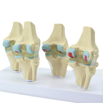 enovo頤諾人體病理膝關節模型 退行性血友病模型骨科疼痛管骨骼模型膝