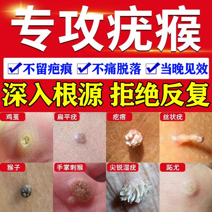 去祛疣体100特专用扁平疣丝状疣瘊子去脖子上的小肉粒去除疣类药 100特效1盒【扁平疣丝状疣】【图片 价格 品牌 报价】-京东