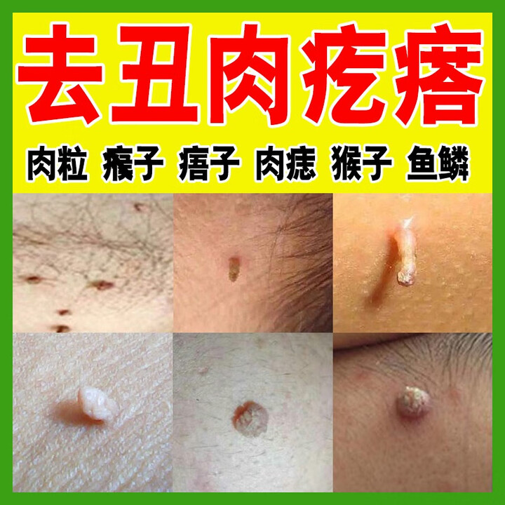 瘊子去除神器疣清宁刺瘊子皮赘去猴子脖子长小肉粒疙瘩肉疣瘊 1盒装【图片 价格 品牌 报价】-京东