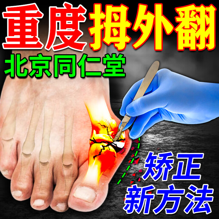 同仁堂拇指外翻贴膏药大脚趾关节痛拇囊炎拇指外翻矫正神器大脚骨专用贴 买2送1【矫正不开刀】(发货特效快)【图片 价格 品牌 报价】-京东
