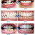 叶露子叶露子儿童牙齿器不整齐龅牙天包地纠正器4-16岁牙齿器隐形牙套透明 牙套第二阶段(加牙盒) 儿童专用款