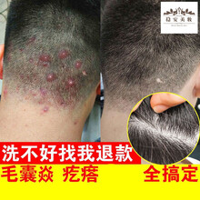 头上长疙瘩 去螨虫去屑止痒头皮洗发水露中药专用改善头痒控油除螨炎去疙瘩外用 大头皮屑 2盒(头皮屑)