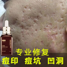 草本旋律 中大祛痘印水杨酸果酸去男士女痘坑修复凹洞痘疤淡化痘印收缩毛孔玻色因精华液补水保湿细嫩去闭口 1瓶25ml