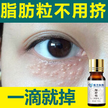 【南方协和】新款草本祛眼部油脂粒脂肪粒汗管瘤眼霜膏脂肪粒淡化黑眼圈袋眼部细纹 3瓶一周期